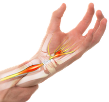 Carpal tunnel syndrome